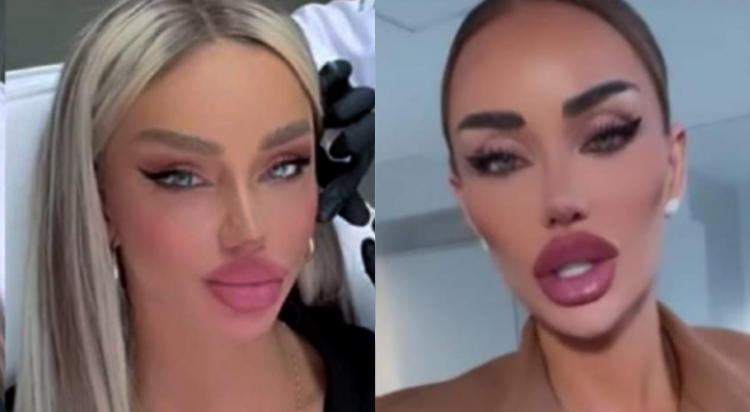 Bianca Drăgușanu, diva răvășitoare cu cele mai frumoase buze care au existat vreodată pe teritoriul României, a dat 11.000 de euro pe ultima intervenție estetică